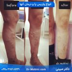 انواع واریس پا