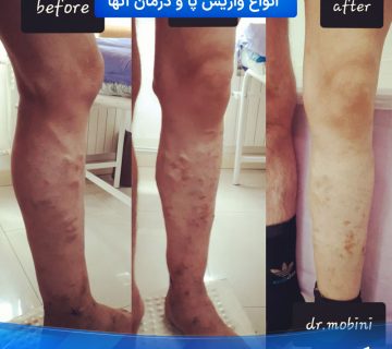 انواع واریس پا