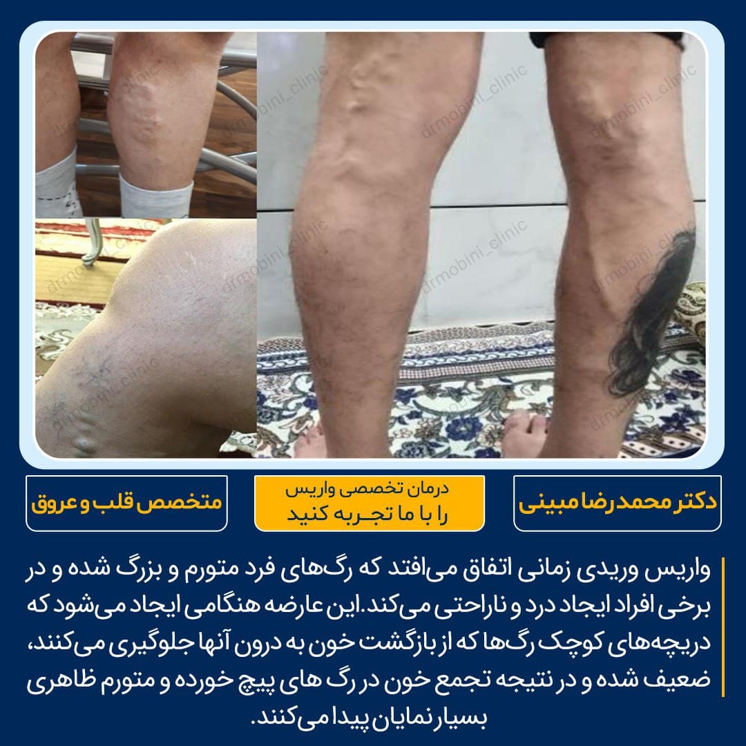 واریس شدید پا
