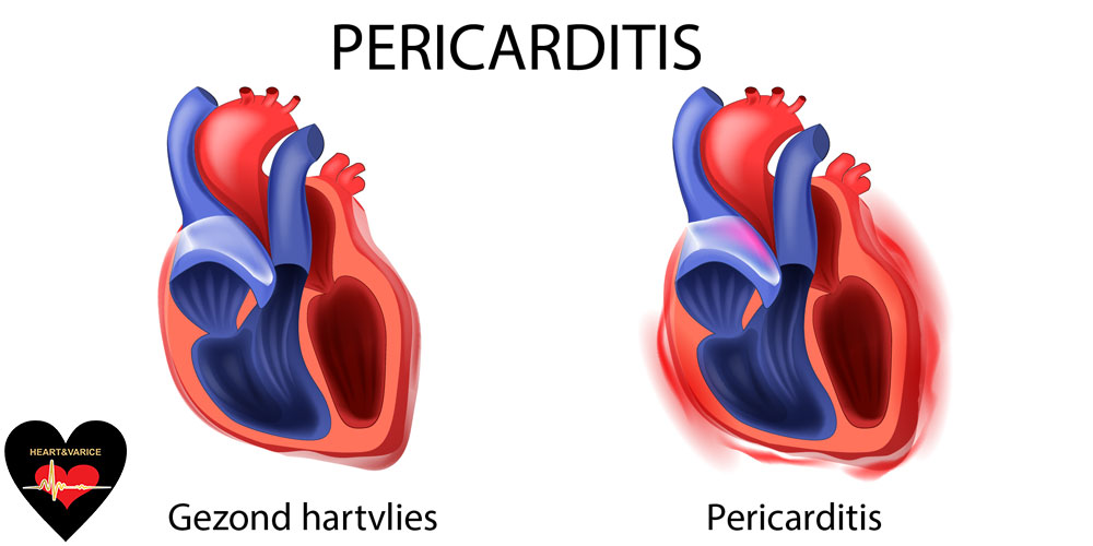 پریکاردیت یا التهاب پرده دور قلب