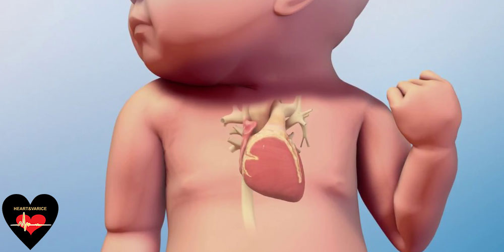 سوراخ قلب نوزاد