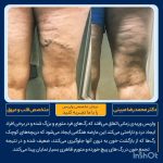 درمان واریس ران پا نمونه کار شماره ۱۲