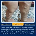 درمان واریس ساق پا در تهران نمونه کار شماره ۱۳