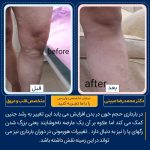 درمان واریس پا در تهران شماره 5