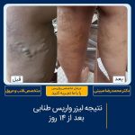درمان واریس طنابی با لیزر در تهران نمونه کار ۱۶