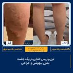 درمان واریس طنابی در تهران نمونه کار شماره ۲۴