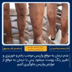 درمان واریس پا در تهران نمونه کار ۲۵