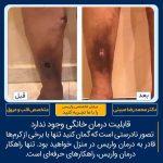 درمان زخم در تهران نمونه کار شماره ۱
