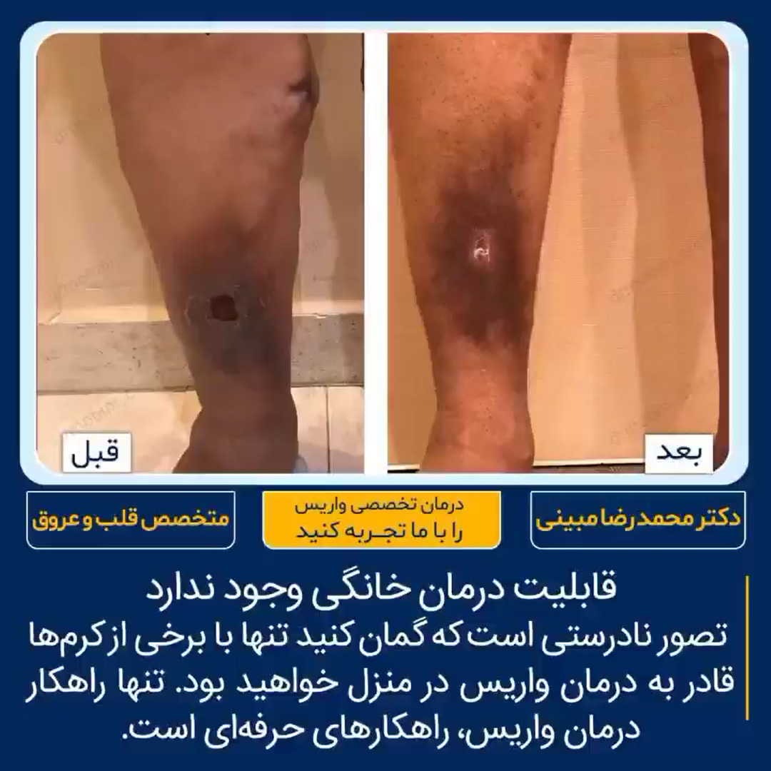 درمان زخم در تهران نمونه کار شماره ۱