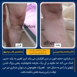 نمونه کار درمان واریس پا در تهران شماره 28