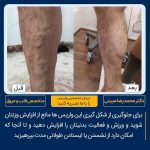 درمان واریس ساق پا نمونه کار 32
