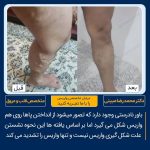 درمان واریس ساق پا در تهران نمونه کار ۳۳