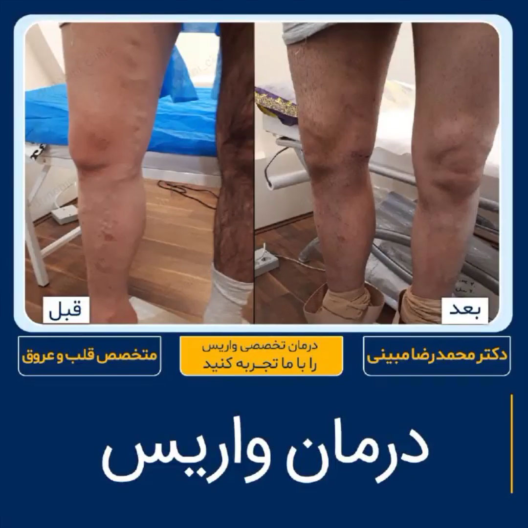 واریس ساق پا در تهران - نمونه کار 38