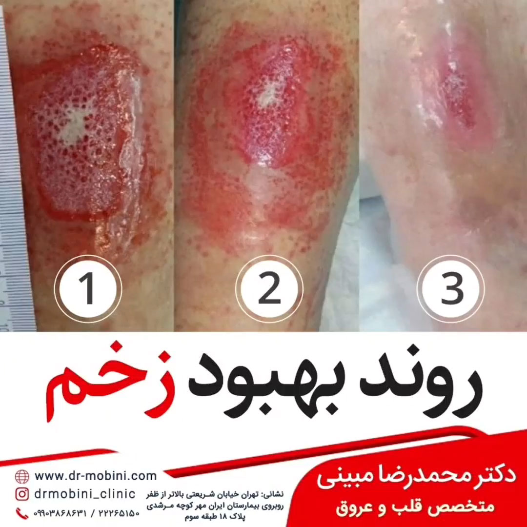درمان زخم واریسی در تهران نمونه کار 3