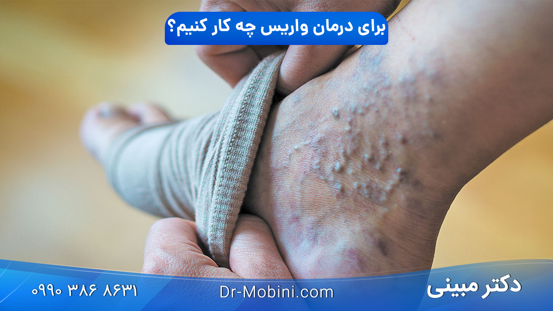 برای درمان واریس چه کار کنیم؟